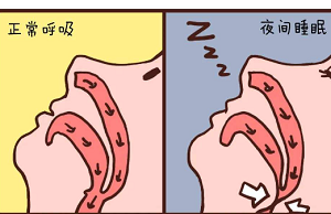睡眠呼吸暂停综合症的症状与治疗