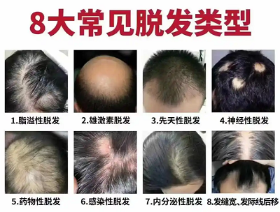 脱发的主要原因是什么？