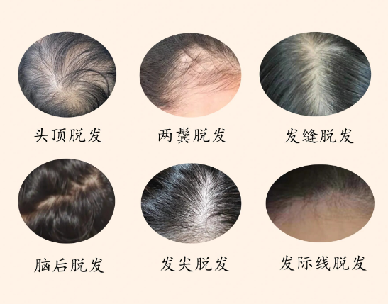 脱发治疗过程中可能会遇到哪些副作用？