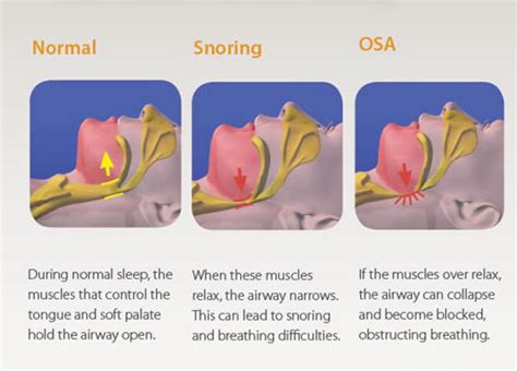 Sleep Apnoea | Modern Dentistry | Canberra Dentist