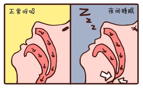 什么是混合性睡眠呼吸暂停综合征？
