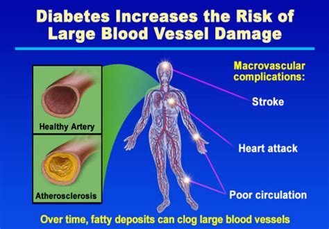 Macrovascular Complications Of Diabetes