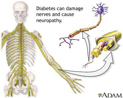 Diabetic Neuropathy Sy…