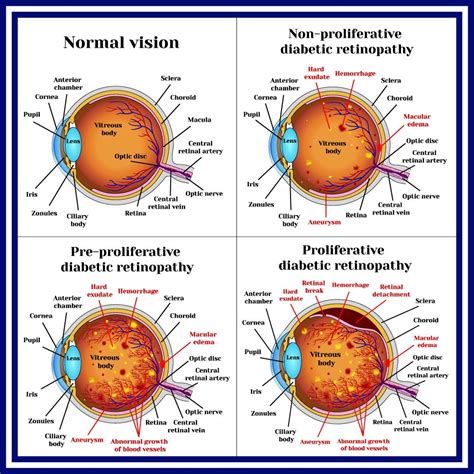 Diabetic Retinopathy Causes, Symptoms, Pr…