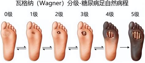 糖尿病足截肢了就没事了吗？