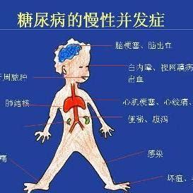 糖尿病并发症