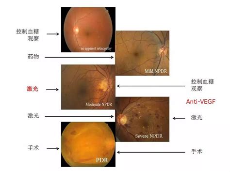 PPARγ-MAPK信号通路在糖尿病视网膜病变发病中的作用