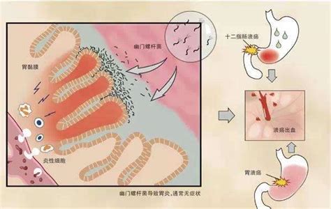 为什么说“幽门螺杆菌”是导致“慢性胃炎”的主要病因？