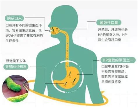 感染了幽门螺杆菌，有哪些症状？后果怎样？