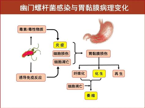  幽门螺杆菌与胃粘膜病例变化