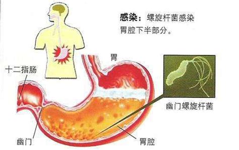 幽门螺旋杆菌如何治疗？