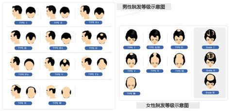 关于脱发等级的简单参照 - 知乎