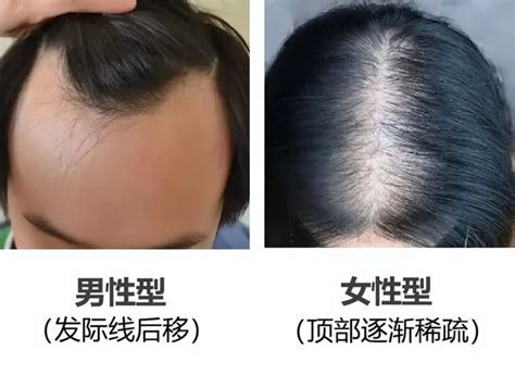 雄性激素脱发如何治疗？ - 知乎