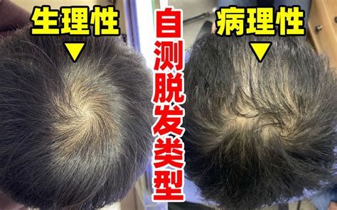 病理性的脱发三大表现，看看你中招没 ？