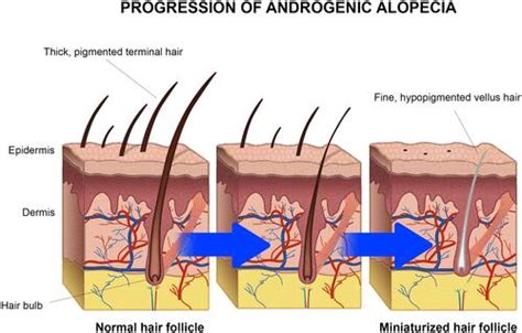 Full article: Topical Treatment for Scarring and Non-Scarring Alopecia ...