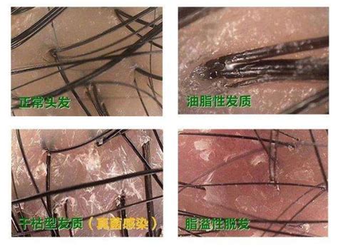 毛囊检测有什么用？为什么医生总叫你去做？