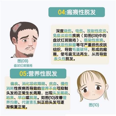 医美、脱发类型 脱发原因