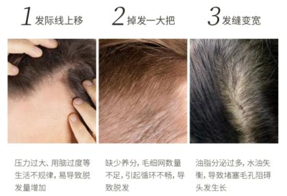 掉发多少才算是脱发？关于洗头与脱发的真相 - 知乎