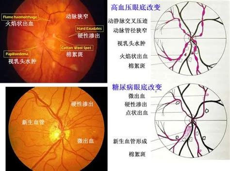有高血压的你当心眼底病变-搜狐大视野-搜狐新闻